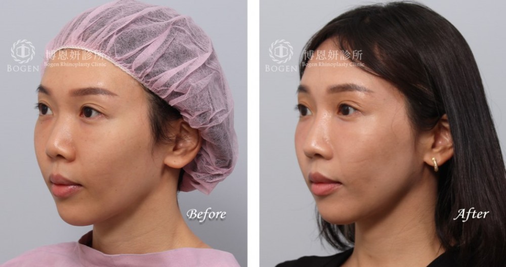 韓式隆鼻,結構式隆鼻,博恩妍